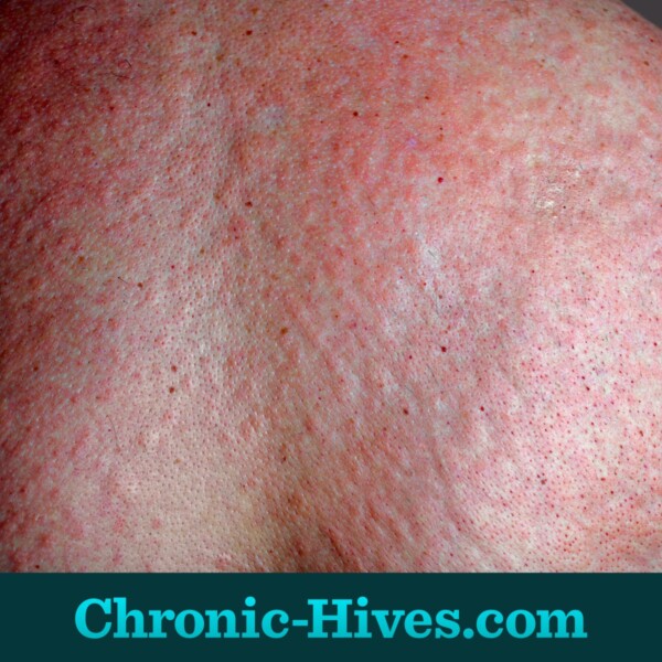 Chronic hives cause red or skin-colored welts that appear anywhere on the body, often covering large areas of skin.