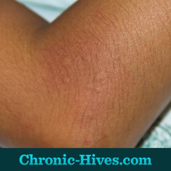 Chronic hives can be harder for doctors to diagnose on darker skin.