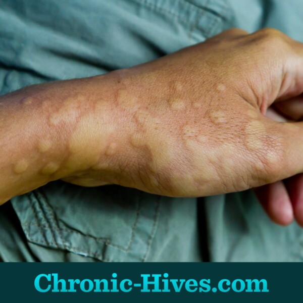 Chronic hives cause swelling in addition to red welts and itching.