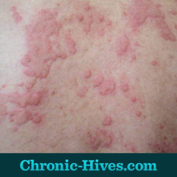 Chronic hives tend to cover large areas of the body compared to short-term hives.